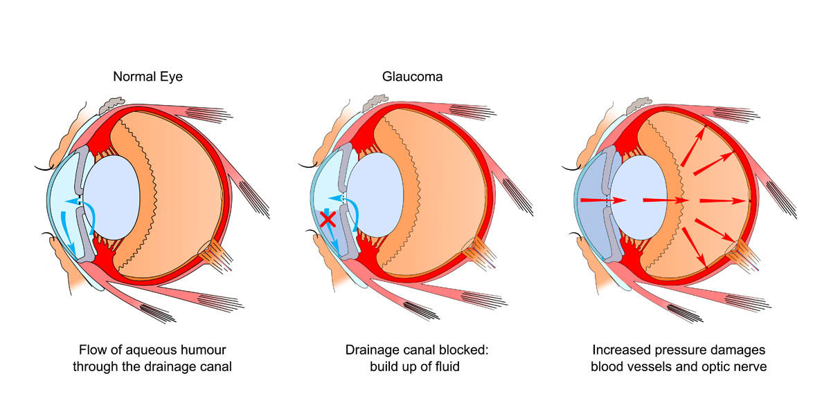 Glaucoma in cats