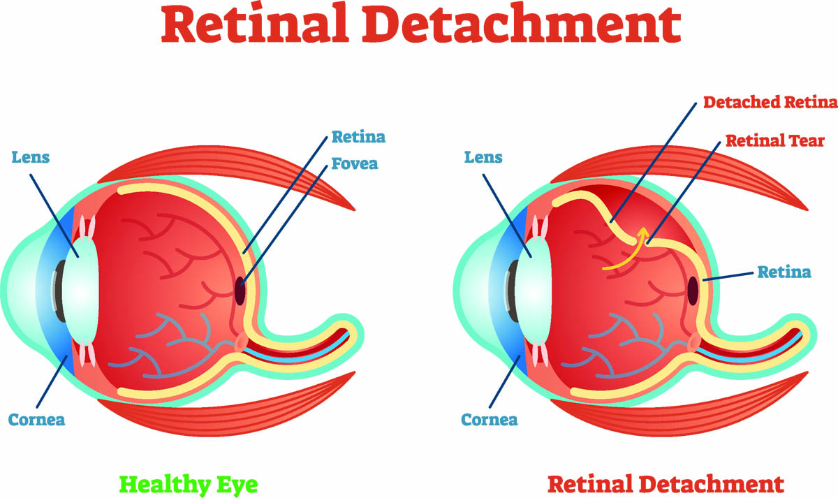 Retinal detachment in cats