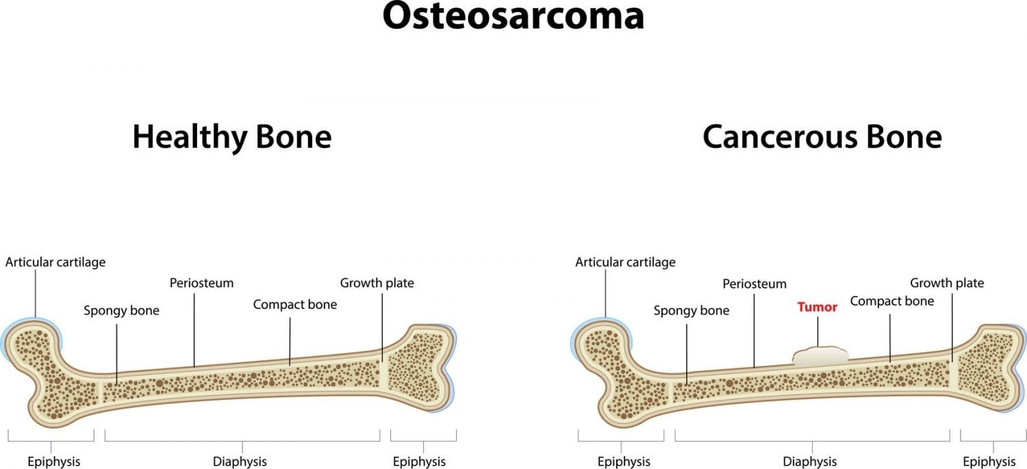 Osteosarcoma in cats