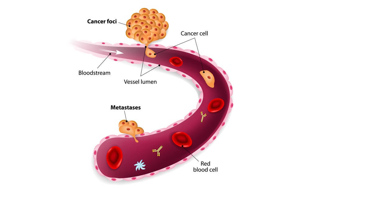 Cancer metastasis