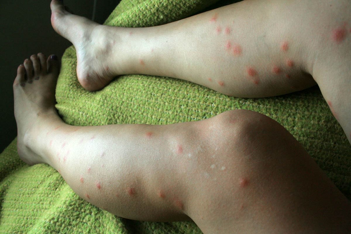 Chiggers bites on a woman's legs