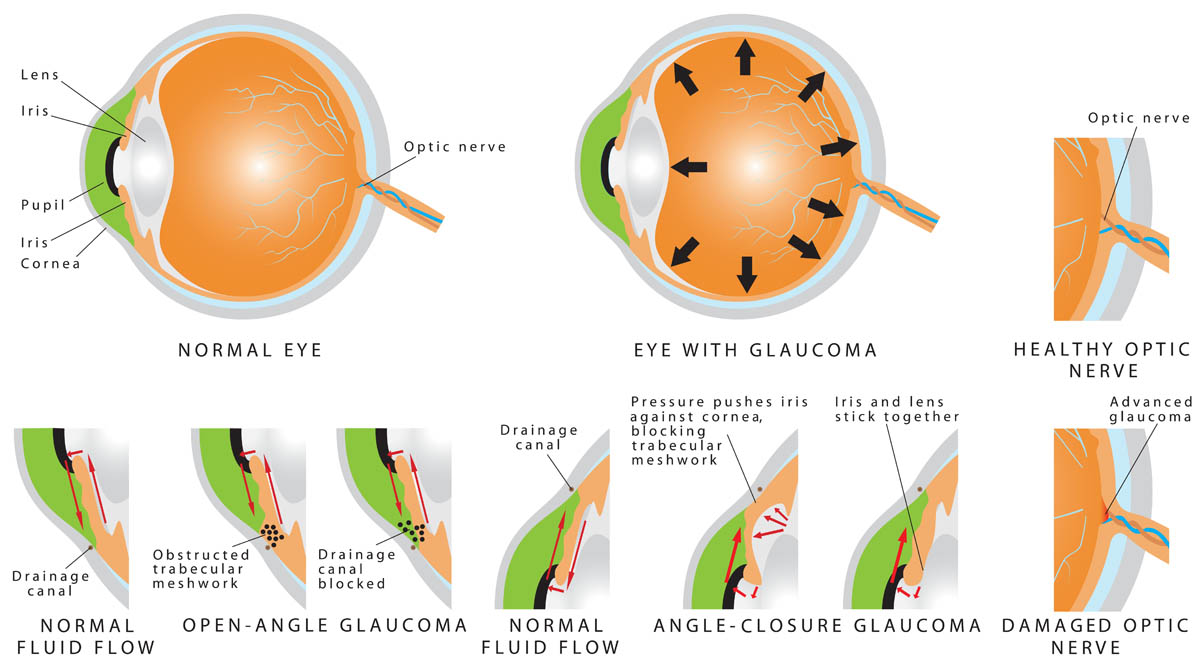 Pathophysiology of glaucoma