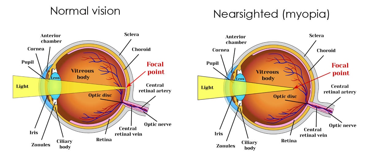 Normal vision compared to nearsighted (myopia)